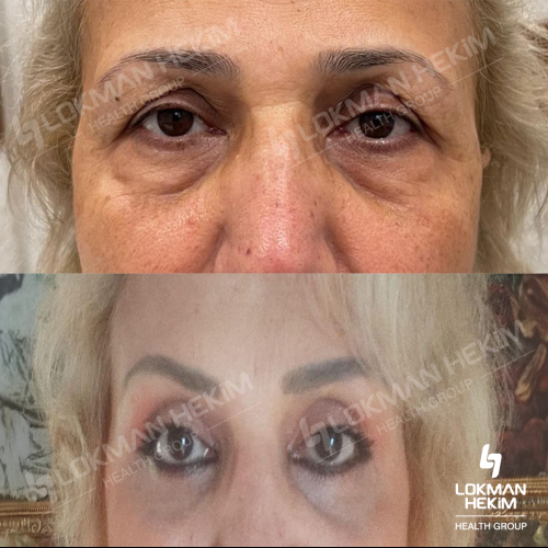 Lifting du visage Photo avant/après